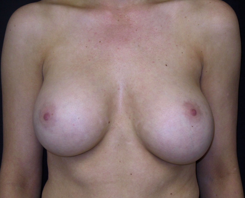 Breast Augmentation Los Angeles California