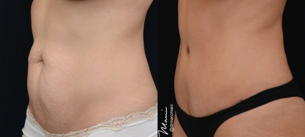 Abdominoplasty (tummy tuck) by Dr. Mani