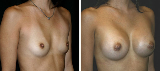 Breast Augmentation by Dr. Mani (periareolar incision)