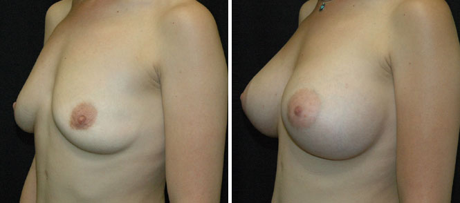 Breast Augmentation by Dr. Mani – transaxillary (armpit) incision