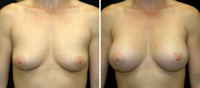 Breast Augmentation by Dr. Mani – transumbilical (belly button) incision