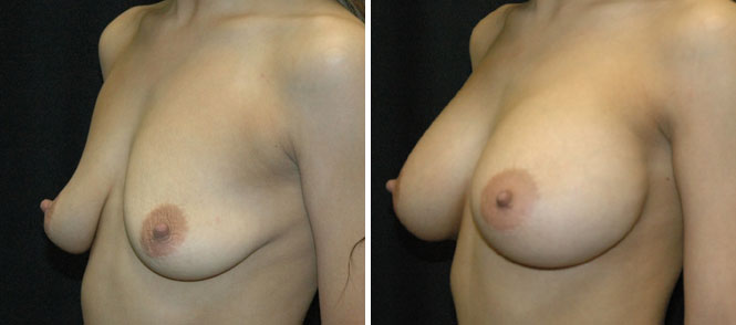 Breast Augmentation by Dr. Mani – inframammary (under breast) incision
