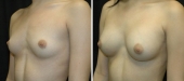 Breast Augmentation by Dr. Mani – transaxillary (armpit) incision