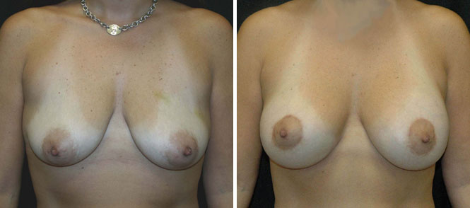 Breast Lift (mastopexy) and Reduction