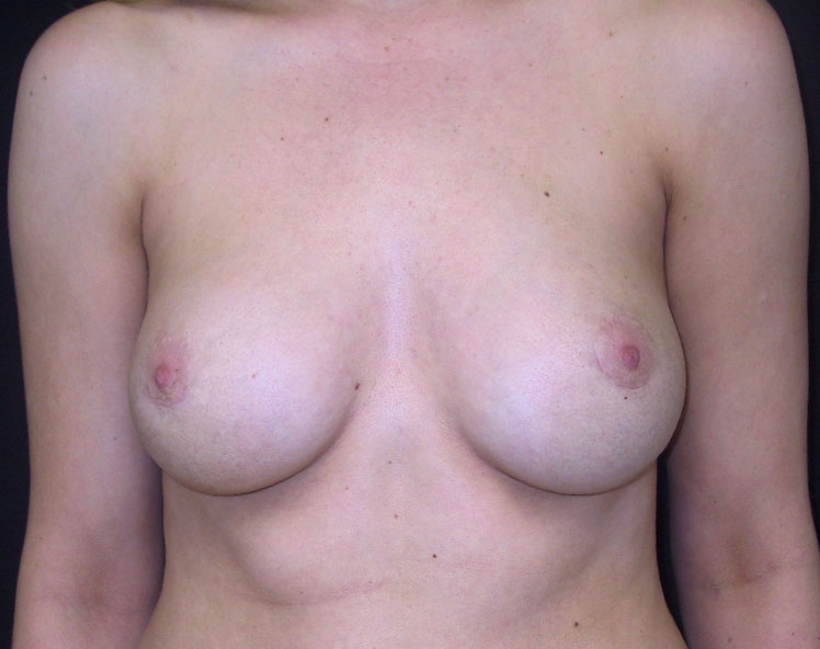 Breast Augmentation Los Angeles California