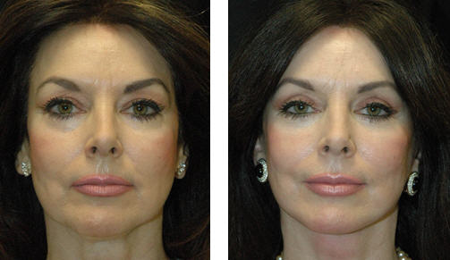 Patient before and after photo that underwent blepharoplasty
