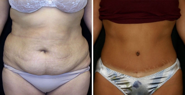 Tummy Tuck (Abdominoplasty)