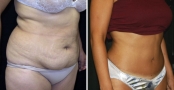 Abdominoplasty