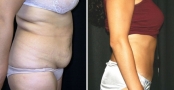 Abdominoplasty