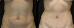 Abdominoplasty
