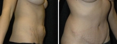 Abdominoplasty