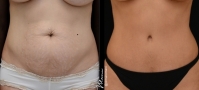 Abdominoplasty (tummy tuck) by Dr. Mani