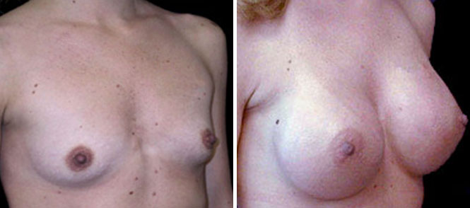 Breast Augmentation by Dr. Mani, transumbilical (belly button) incision