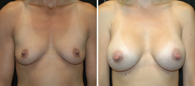 Breast Augmentation by Dr. Mani – periareolar (under areola) incision