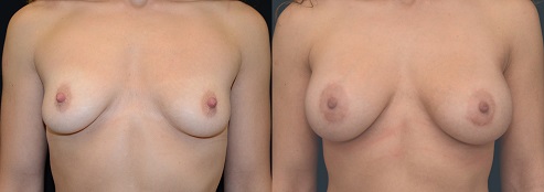 Breast Augmentation by Dr. Mani - periareolar incision