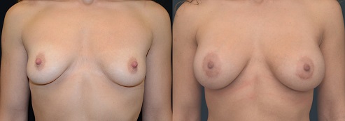 Breast Augmentation Before and After