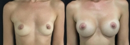 Breast Augmentation by Dr. Mani - inframammary (under breast) incision