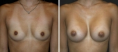 Breast Augmentation by Dr. Mani (periareolar incision)