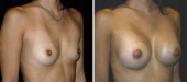 Breast Augmentation by Dr. Mani (periareolar incision)