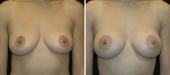 Breast Augmentation by Dr. Mani – inframammary (under breast) incision
