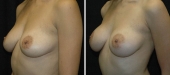 Breast Augmentation by Dr. Mani – inframammary (under breast) incision
