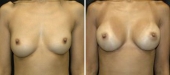 Breast Augmentation by Dr. Mani – transaxillary (armpit) incision