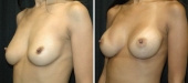 Breast Augmentation by Dr. Mani – transaxillary (armpit) incision