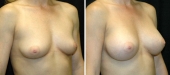 Breast Augmentation by Dr. Mani – transumbilical (belly button) incision