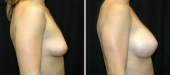 Breast Augmentation by Dr. Mani – transumbilical (belly button) incision