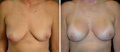 Breast Augmentation by Dr. Mani (periareolar incision)