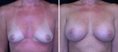 Breast Augmentation by Dr. Mani, transumbilical (belly button) incision