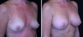 Breast Augmentation by Dr. Mani, transumbilical (belly button) incision