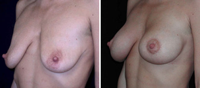 Breast Reduction Surgery in Beverly Hills