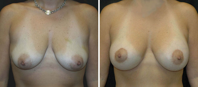 Breast Lift Beverly Hills