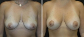 Breast Lift (mastopexy) and Reduction