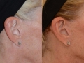 incisions-facelift-20141029122532364-20141029122627448