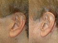 malefaceincision1-424x282