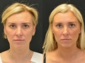 fat-transfer-1