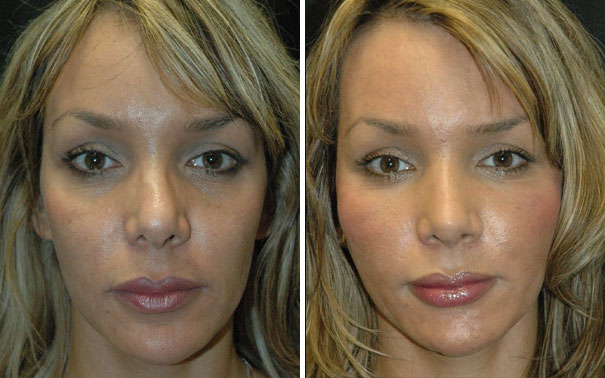 Rhinoplasty before and after