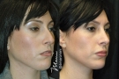 rhinoplasty 0217