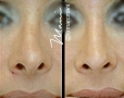 MB crooked nose
