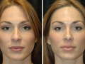 Rhinoplasty