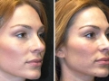 Rhinoplasty