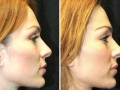 Rhinoplasty