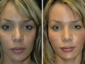 Rhinoplasty