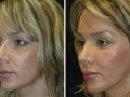 Rhinoplasty