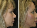 Rhinoplasty