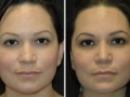 Rhinoplasty