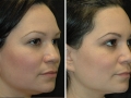 Rhinoplasty