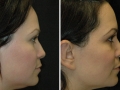 Rhinoplasty